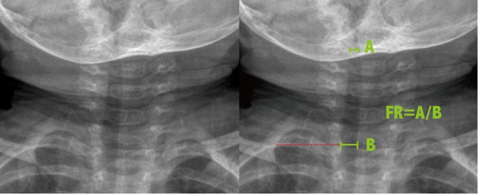 Anteroposterior neck radiograph demonstrating the steeple sign with subglottic narrowing of the tracheal air column characteristic of viral croup in a pediatric patient