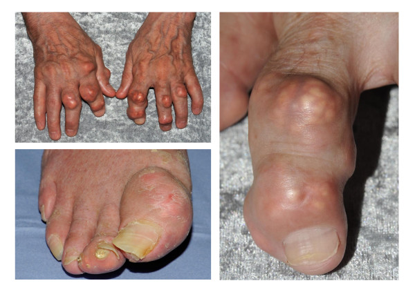 Clinical photograph of tophaceous gout affecting the great toe and finger joints, showing asymmetric swelling and yellow-white discoloration of tophi deposits
