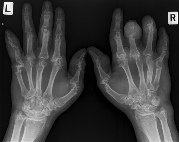 Radiograph of the hand showing periarticular erosions and overhanging edges characteristic of chronic tophaceous gout affecting multiple joints