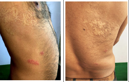 Clinical photograph showing herpes zoster with grouped vesicles on an erythematous base distributed in a dermatomal pattern across the trunk, demonstrating the characteristic unilateral rash
