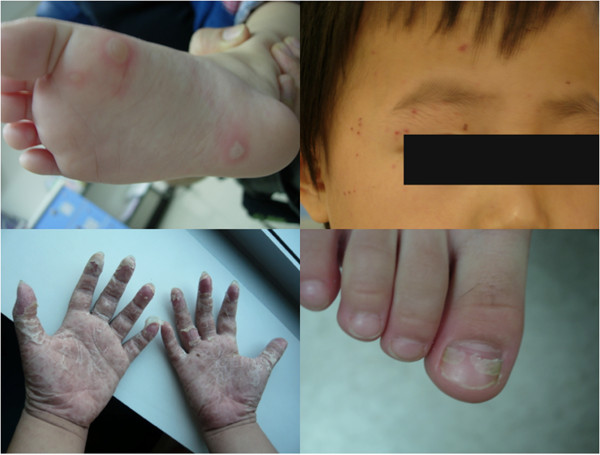 Clinical photographs of hand-foot-mouth disease showing vesicular and bullous lesions on the palms, soles, and oral mucosa in pediatric patients caused by coxsackievirus