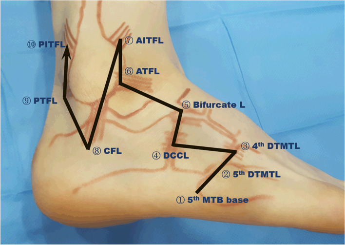 MRI of the lateral ankle showing the anterior talofibular ligament and calcaneofibular ligament complex with surrounding anatomical landmarks