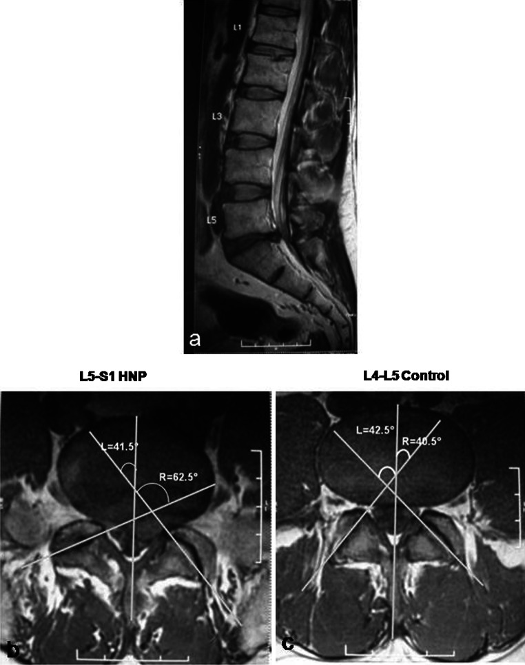 Sagittal and axial MRI of the lumbar spine demonstrating a large posterolateral disc herniation compressing the traversing nerve root with associated facet joint asymmetry