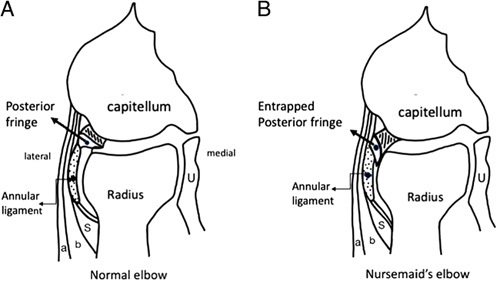 Ultrasound images of the elbow in a child with nursemaid elbow showing the partial eclipse sign with the annular ligament interposed between the radial head and capitellum