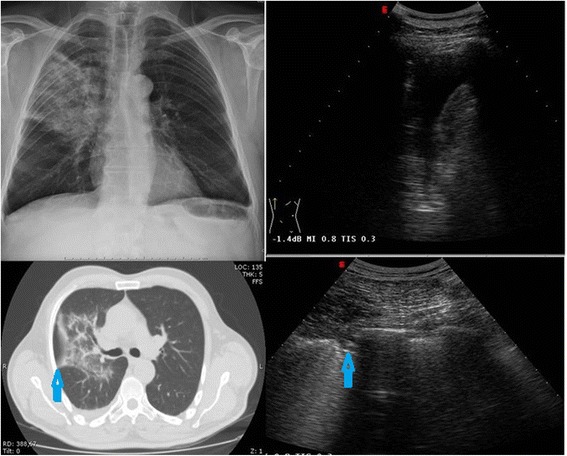 Chest radiograph and CT comparison showing right lobar consolidation consistent with community-acquired pneumonia, with air bronchograms visible on imaging