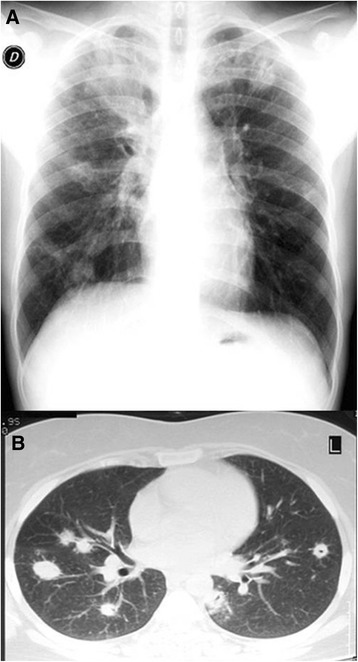 Chest imaging showing multifocal pneumonitis with bilateral infiltrates in an immunocompromised patient, compared across radiograph, CT, and ultrasound modalities