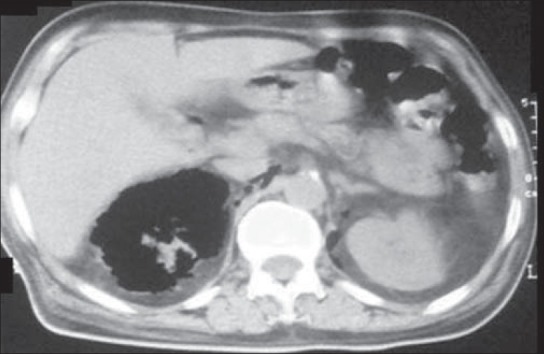 CT scan of the abdomen demonstrating findings of emphysematous pyelonephritis with gas within the renal parenchyma and perinephric tissue, representing a severe upper urinary tract infection