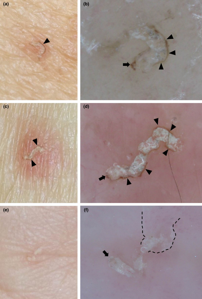 Clinical photograph and dermoscopic image of scabies showing characteristic burrows in the web spaces with dermoscopic visualization of the mite and its track