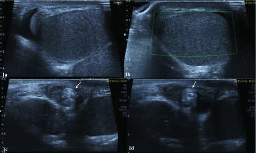 Scrotal ultrasound with Doppler showing absent blood flow to a torsed testicle compared with normal contralateral flow, demonstrating the classic finding in testicular torsion