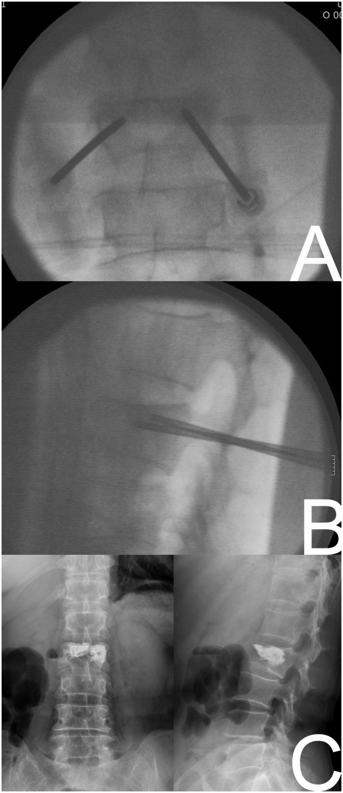 Vertebroplasty procedure showing transpedicular needle placement and PMMA cement injection
