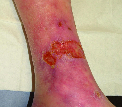 Clinical photograph of an arterial ulcer demonstrating typical skin changes including thin shiny skin and hair loss