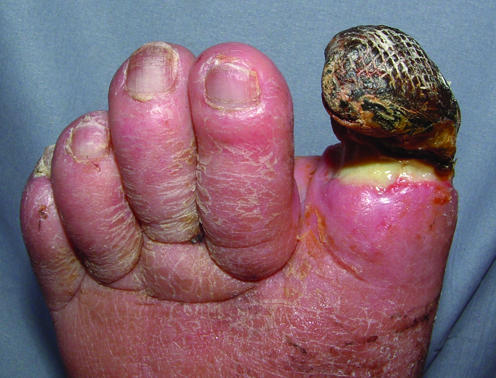 Clinical photograph showing dry gangrene of the great toe with a clear demarcation line in arterial disease