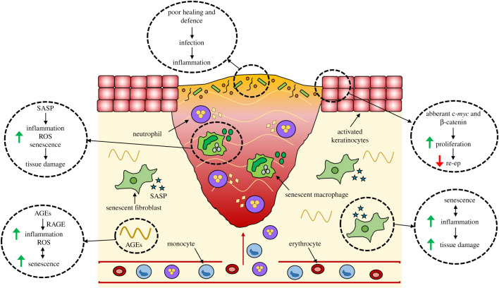 Diagram showing factors contributing to chronic wound healing failure including bacterial infiltration, aberrant keratinocyte activation, senescent cell accumulation, elevated AGEs, and increased inflammation
