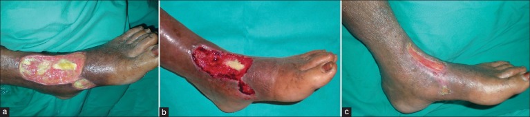 Clinical photographs showing diabetic foot ulcer treatment progression with negative pressure wound therapy, demonstrating initial wound with exposed tendon through contraction and epithelialization
