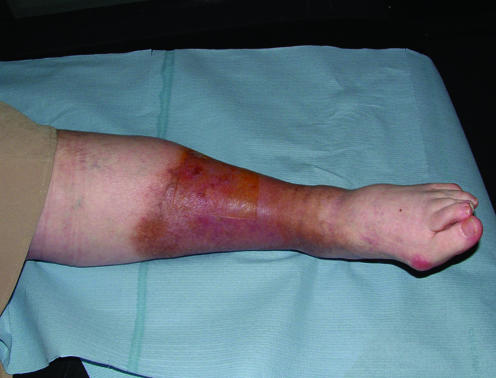 Clinical photograph demonstrating hemosiderin deposition and brown pigmentation around a venous leg ulcer
