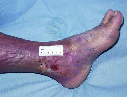 Clinical photograph showing lipodermatosclerosis with woody induration and inverted champagne bottle leg deformity from chronic venous disease