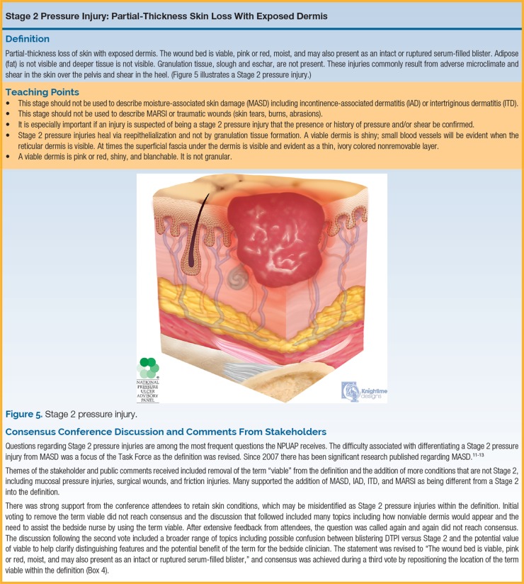 NPUAP illustration of Stage 2 pressure injury showing partial-thickness skin loss with exposed dermis