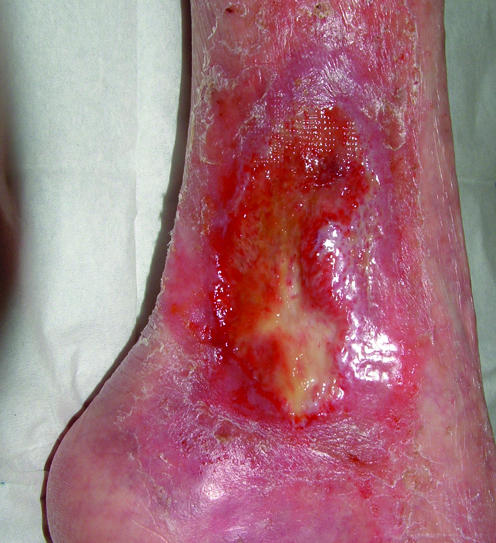 Clinical photograph of a venous ulcer with a fibrinous base located over the malleolus