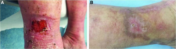 Clinical photographs showing a venous ulcer with granulation tissue treated with hydrocolloid dressing, with before and after healing at 4 weeks