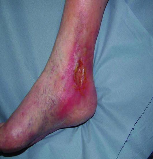 Clinical photograph of a typical venous leg ulcer located over the medial malleolus with irregular borders and granulation tissue