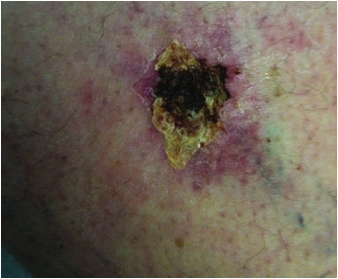 Clinical photograph showing eschar overlying a wound bed with thick adherent fibrinous material requiring debridement