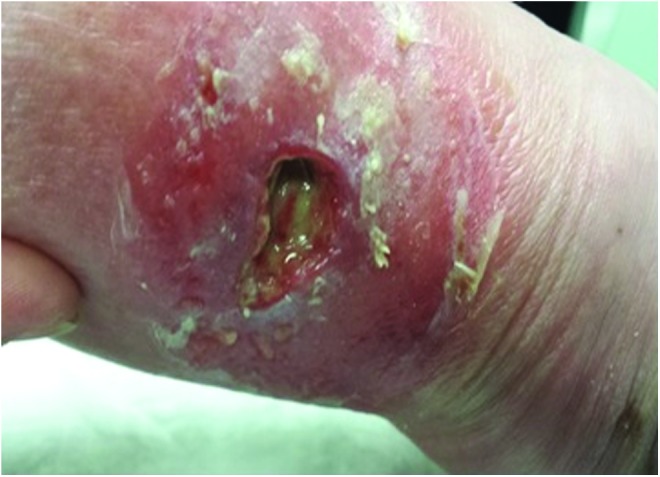 Clinical photograph of a traumatic wound with moderate exudate managed with a hydrofiber dressing