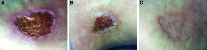 Clinical photographs showing wound progression with collagenase enzymatic debridement and foam dressing through six weeks of treatment