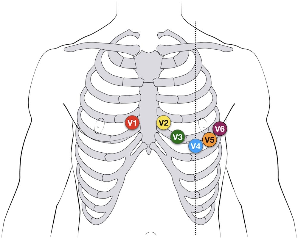 Standard 12-lead ECG electrode placement showing all limb and precordial lead positions on the body