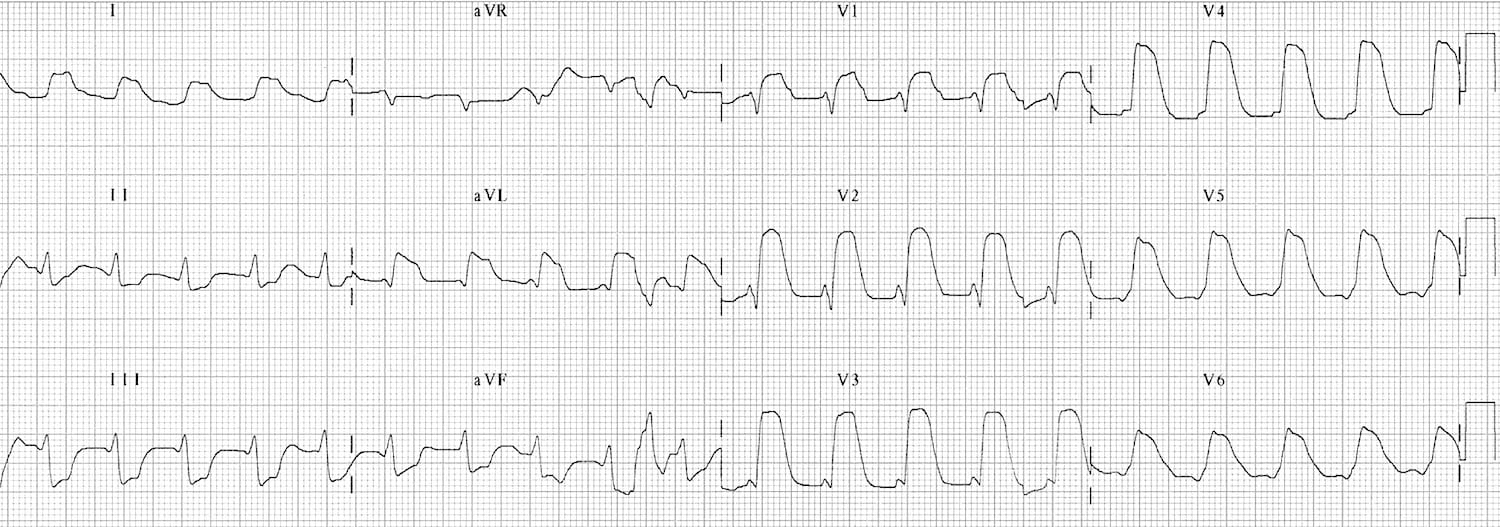 ECG showing tombstoning pattern in extensive anterior STEMI with massive ST elevation merging with T waves