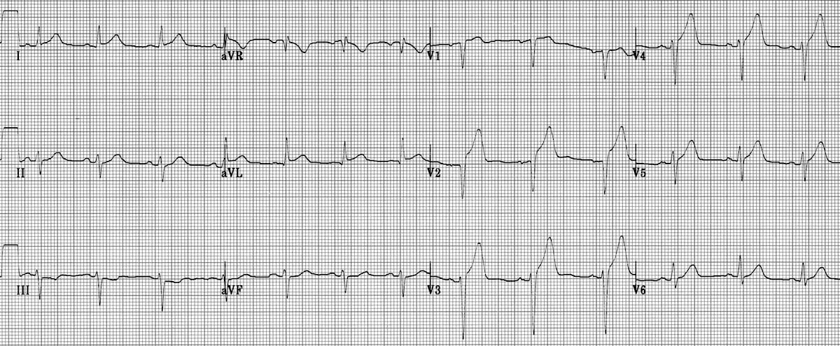 12-lead ECG showing anterolateral STEMI with ST elevation in precordial and lateral leads