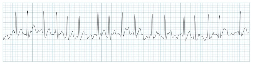 ECG rhythm strip showing atrial fibrillation with irregularly irregular R-R intervals and absence of P waves