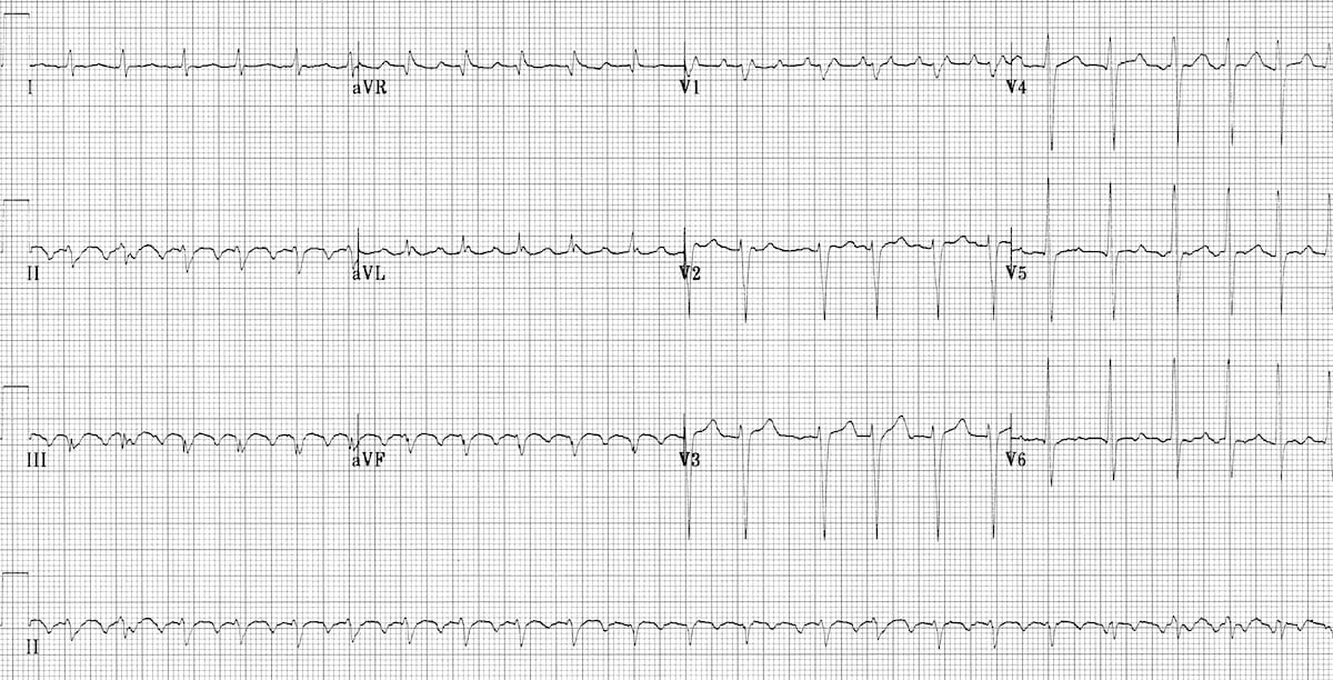 12-lead ECG showing atrial flutter with 2:1 AV block and ventricular rate of approximately 150 bpm