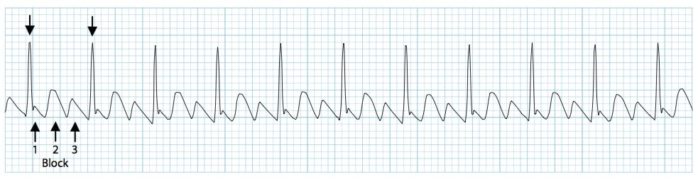 ECG rhythm strip showing atrial flutter with sawtooth flutter waves and 3:1 conduction block