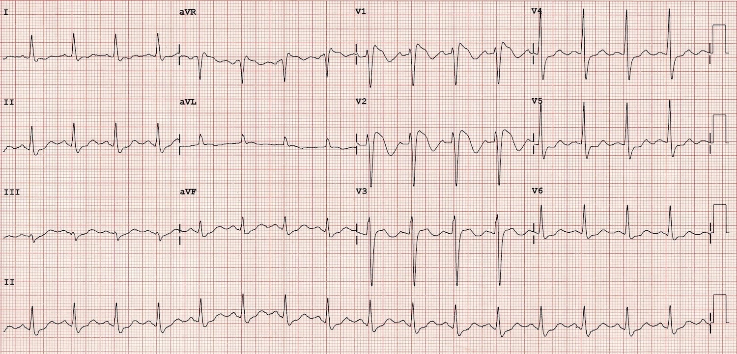 12-lead ECG showing Brugada syndrome type 1 with coved ST elevation greater than 2mm and T wave inversion in V1-V2