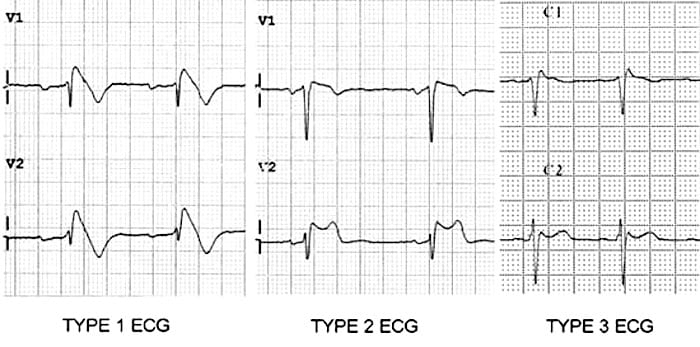 Comparison of Brugada syndrome ECG types 1, 2, and 3 showing coved and saddleback ST elevation patterns in V1-V2