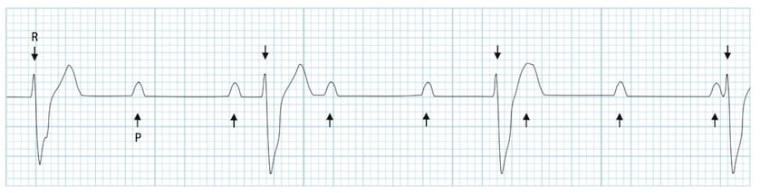 ECG rhythm strip showing third-degree complete heart block with AV dissociation and regular ventricular escape rhythm