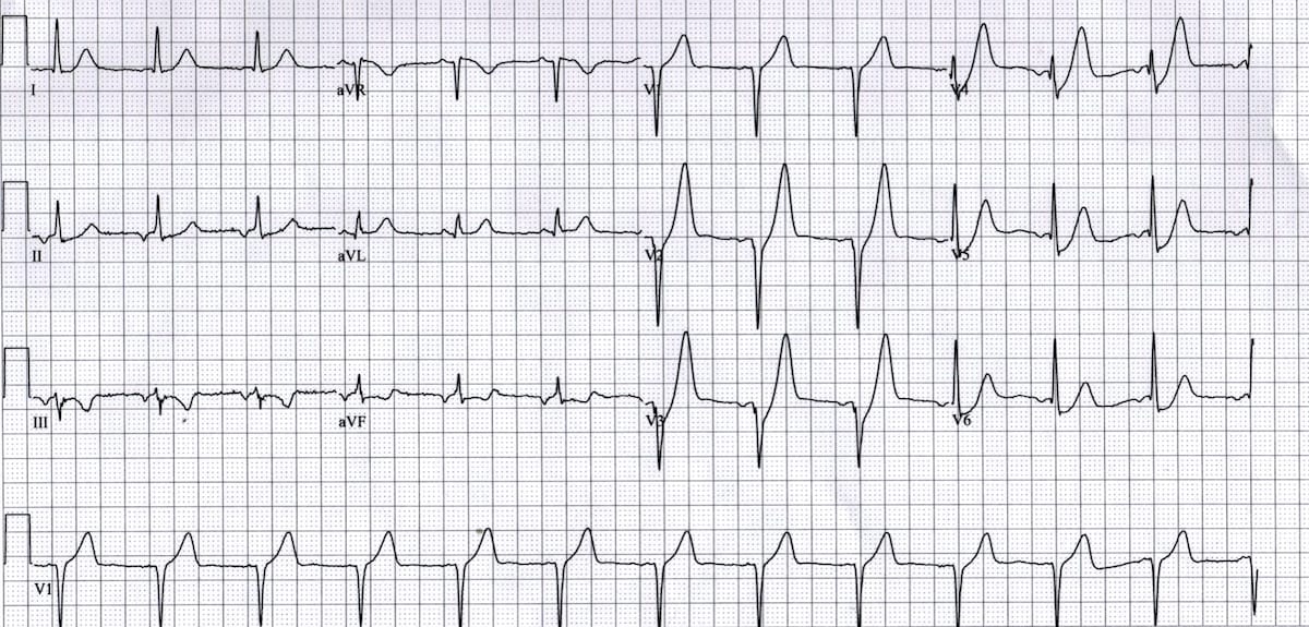 12-lead ECG showing De Winter T wave pattern with upsloping ST depression and tall symmetric T waves in precordial leads