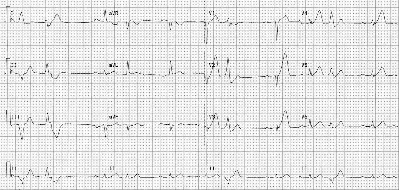 12-lead ECG showing hyperacute anterior STEMI with tall broad T waves and early ST elevation