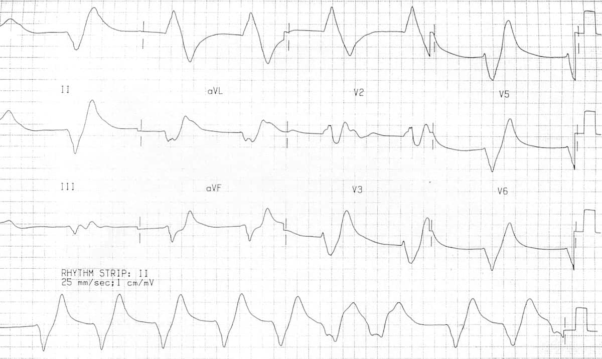 ECG showing severe hyperkalemia with sine wave pattern indicating imminent cardiac arrest
