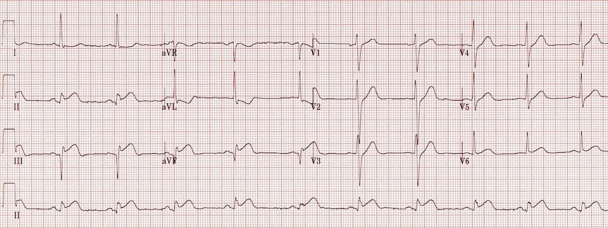 12-lead ECG showing inferior STEMI with ST elevation in leads II III and aVF with reciprocal depression in I and aVL