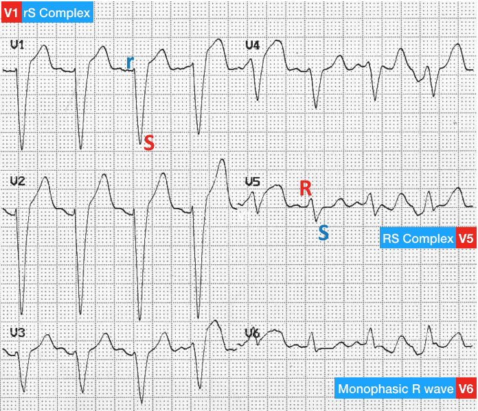 Precordial leads V1-V6 in LBBB showing deep S waves in V1-V2 transitioning to tall R waves in V5-V6