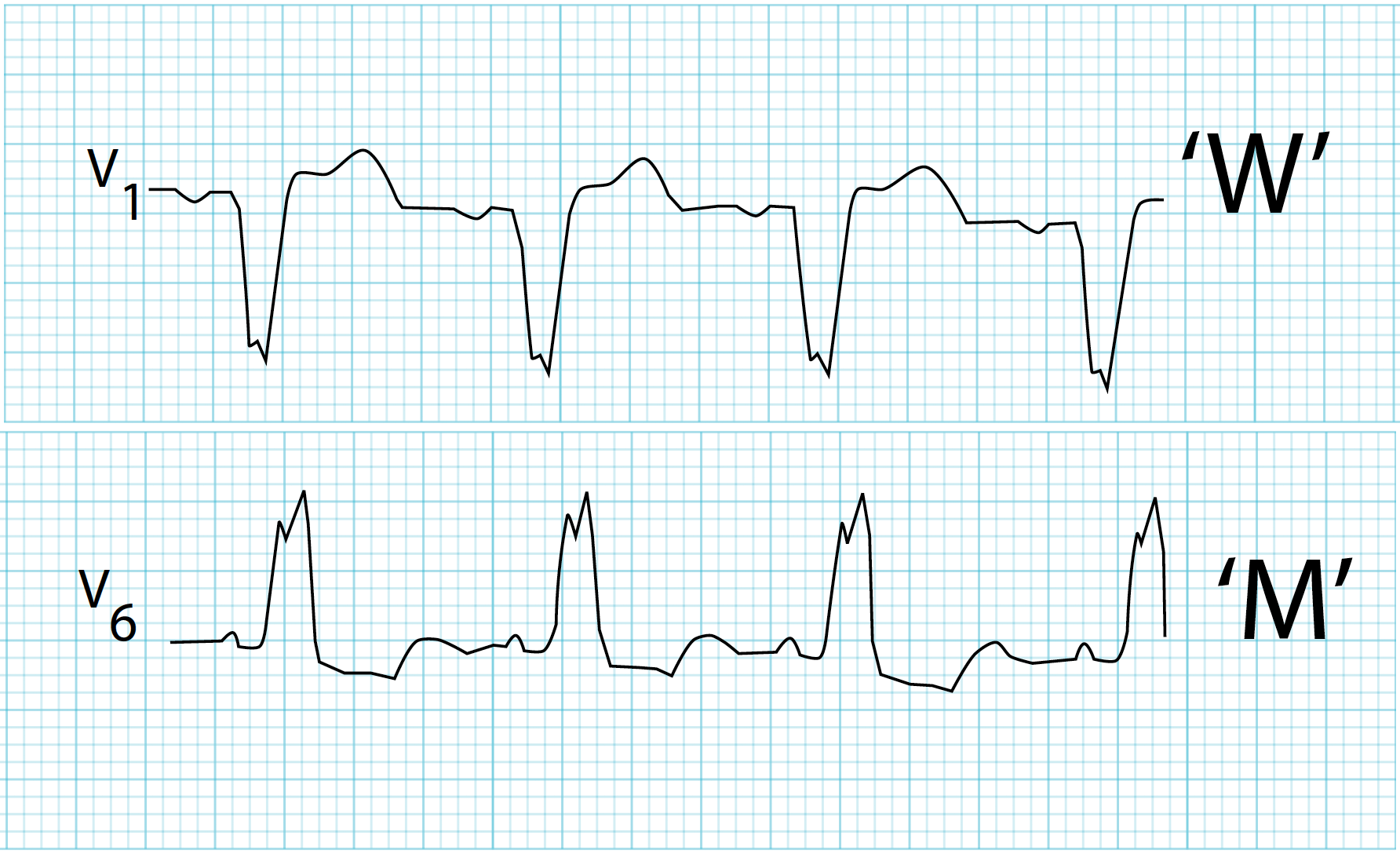 12-lead ECG showing left bundle branch block with broad monophasic R wave in lateral leads and deep S wave in V1