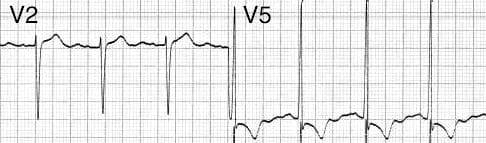 Close-up of V2 and V5 leads showing markedly increased QRS voltage meeting Sokolow-Lyon LVH criteria