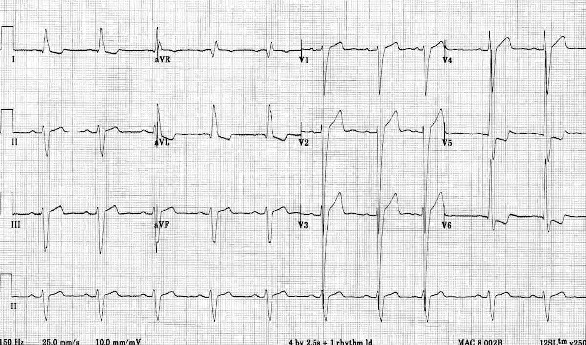 12-lead ECG showing left ventricular hypertrophy with increased voltage and lateral strain pattern