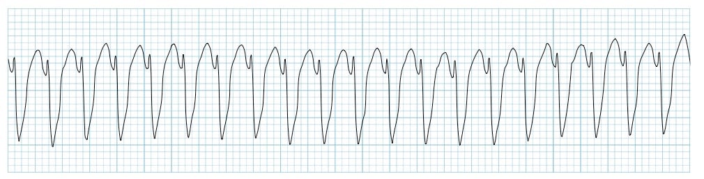ECG rhythm strip showing monomorphic ventricular tachycardia with wide uniform QRS complexes at rapid rate
