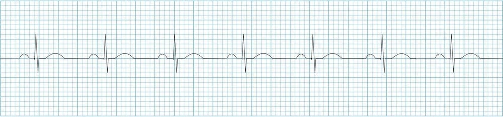 ECG rhythm strip showing normal sinus rhythm with labeled RR intervals for rate calculation