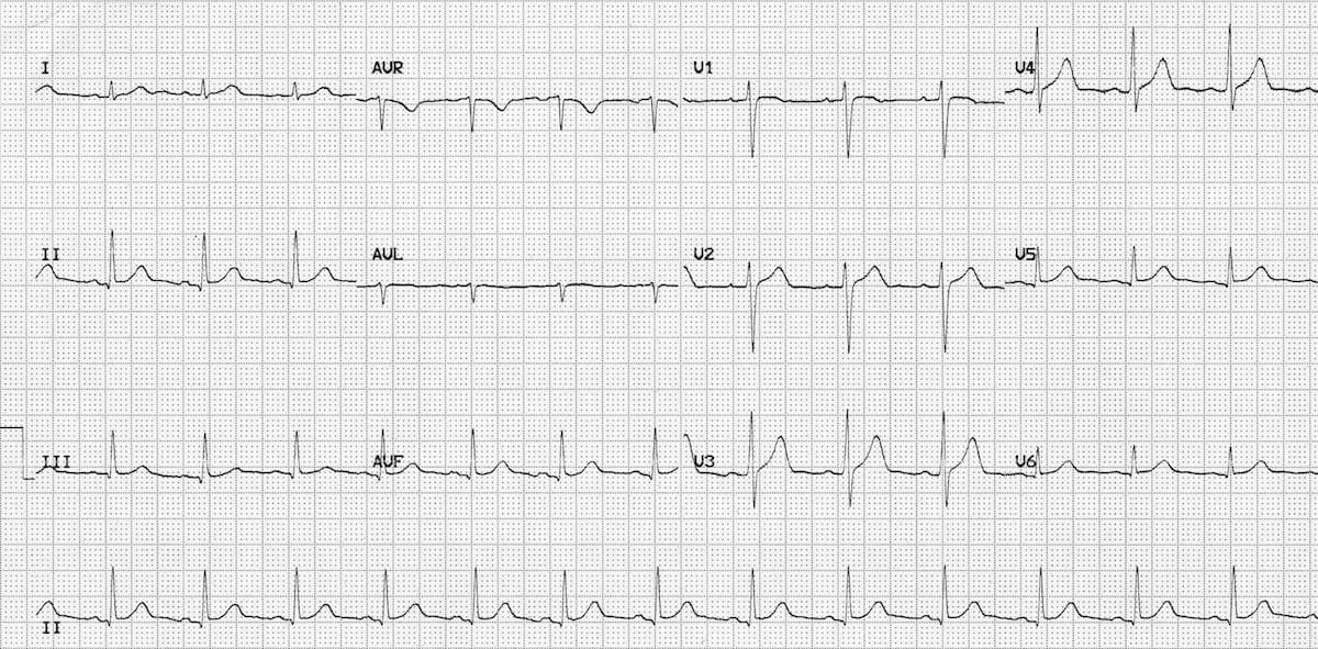 12-lead ECG showing normal sinus rhythm with regular rate, upright P waves, and normal intervals