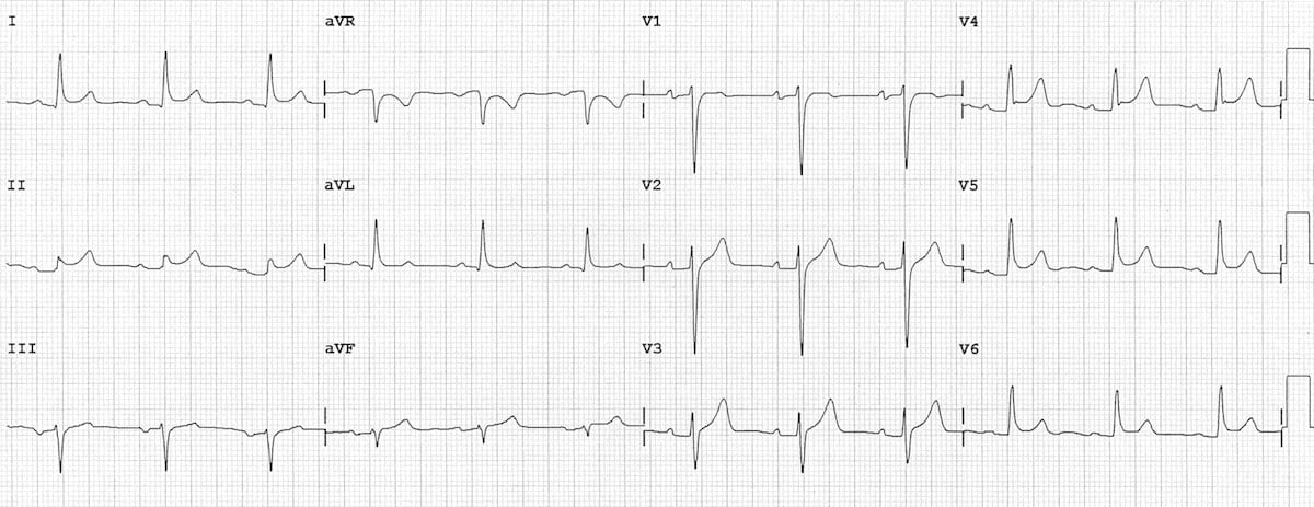 12-lead ECG showing acute pericarditis with diffuse concave ST elevation and PR depression