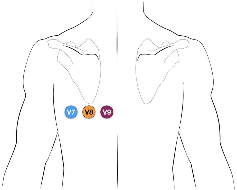 Posterior ECG leads V7 V8 V9 placement on the back for posterior STEMI diagnosis
