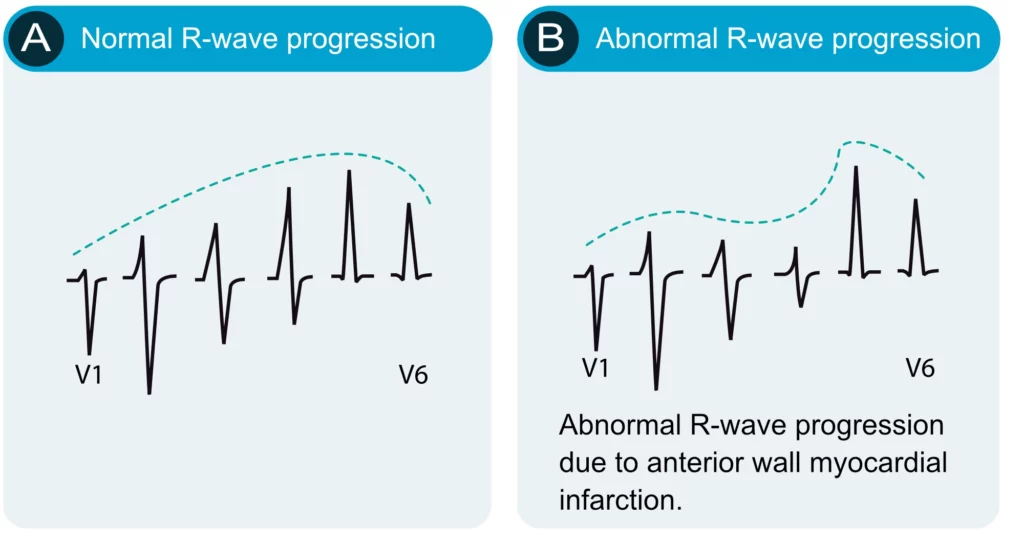 Normal R wave progression across precordial leads V1 through V6 showing increasing R wave amplitude and decreasing S wave depth